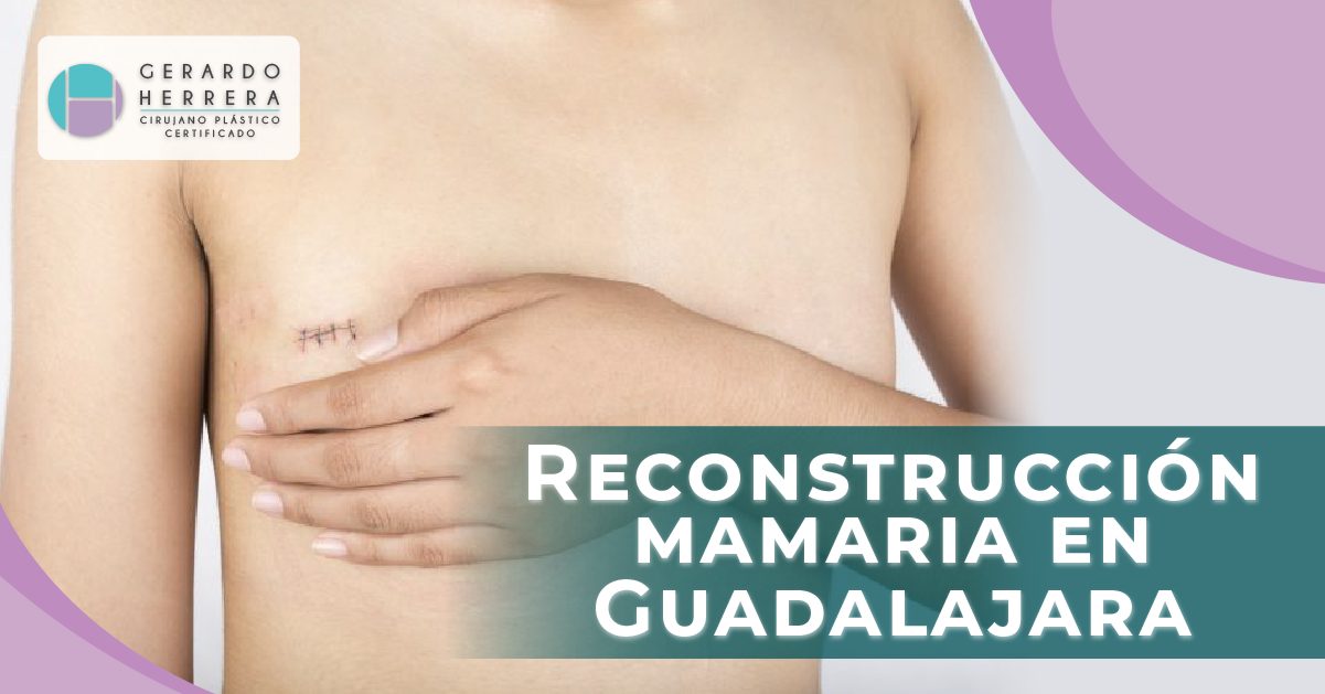 Técnicas de Reconstrucción mamaria en Guadalajara